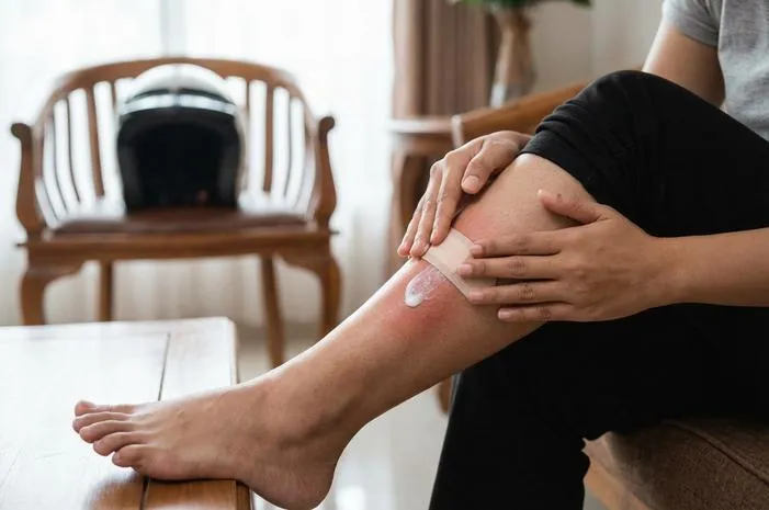 Cara Mengobati Luka Bakar Knalpot Agar Cepat Sembuh