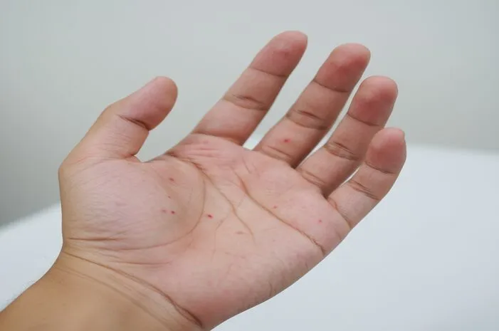 Telapak Tangan Bintik Merah? Penyebab dan Solusi Mudah