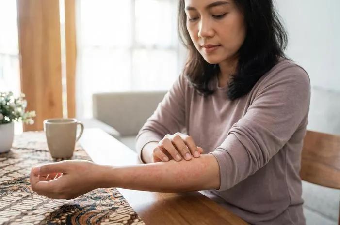 Kenali Ruam Merah Setelah Demam pada Orang Dewasa