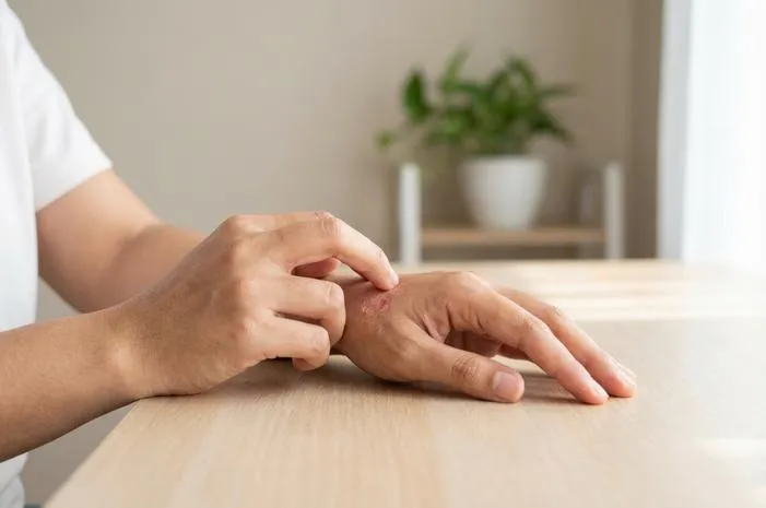 Yuk Kenali Ciri Ciri Kutu Air di Tangan, Awas Jamur