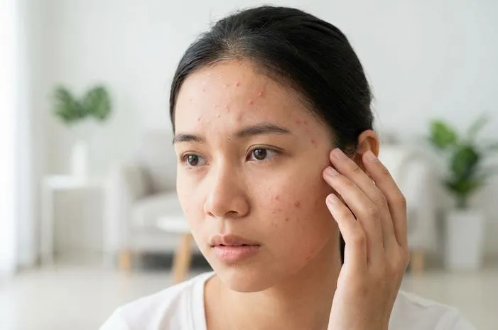 Keringat Buntet di Wajah? Ini Cara Ampuh Mengatasinya