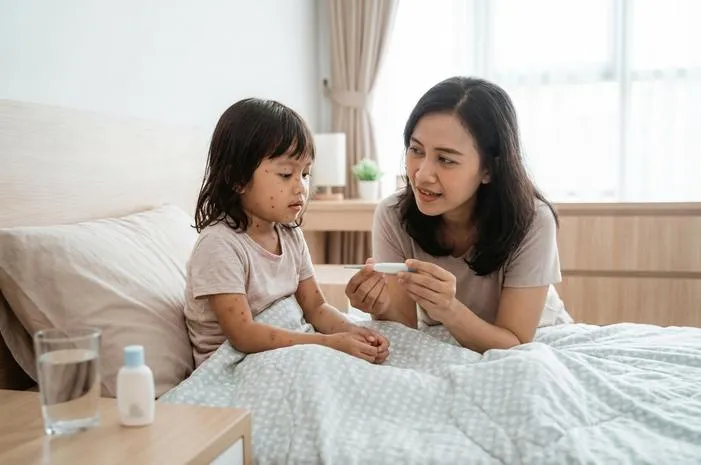 Cacar Air pada Anak Berapa Lama Sembuh?