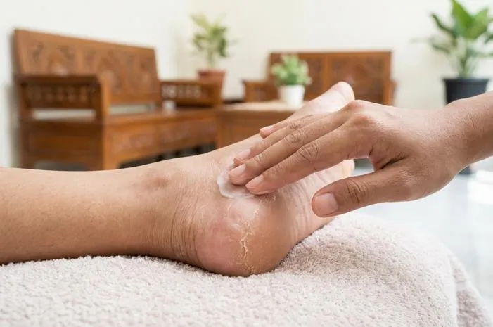 Penyebab Kulit Kaki Mengelupas Agar Tak Kambuh Lagi
