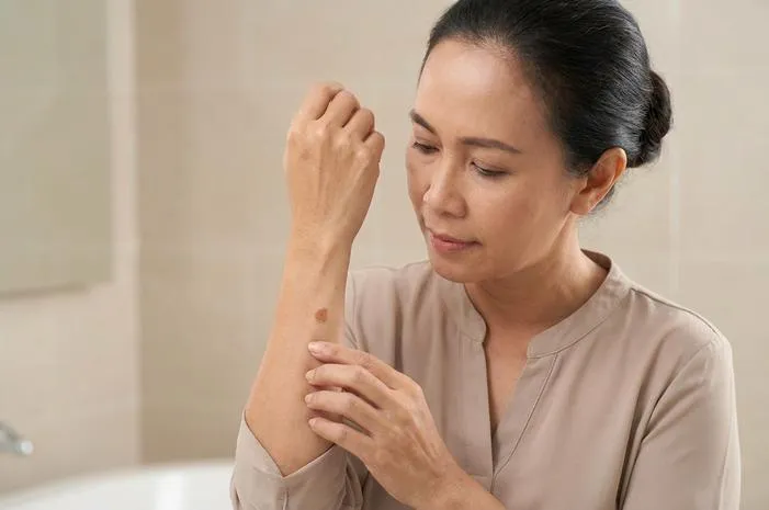 Wajib Tahu! Arti Bercak Coklat di Kulit dan Area Wanita