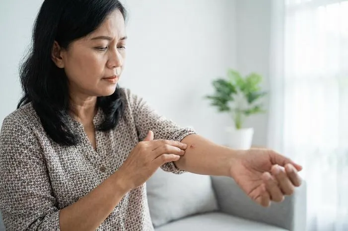 Cacar Batu: Ini Dia Gejala dan Tips Pencegahannya