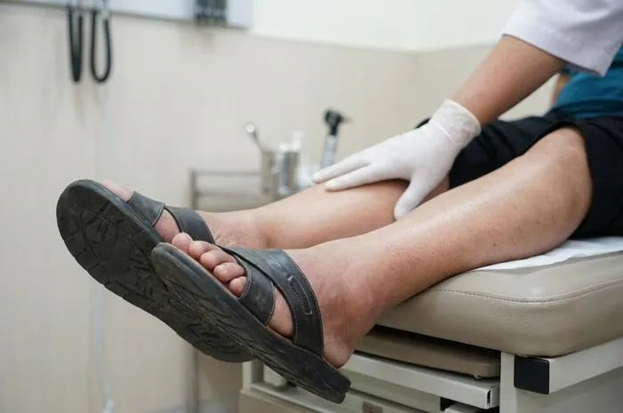 Edema Anasarka ICD 10: Pahami Kode R60.1