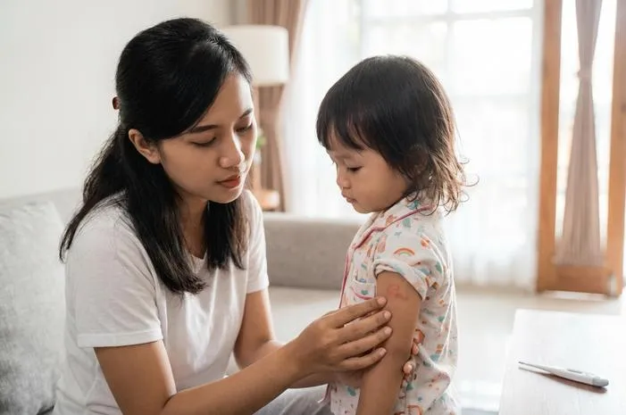 Ciri-ciri Campak: Gejala Awal hingga Ruam Merah