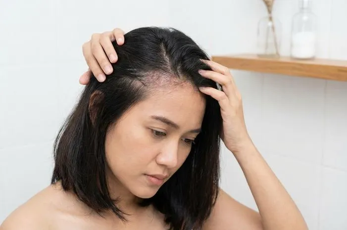Atasi Psoriasis Scalp: Kulit Kepala Bebas Gatal!
