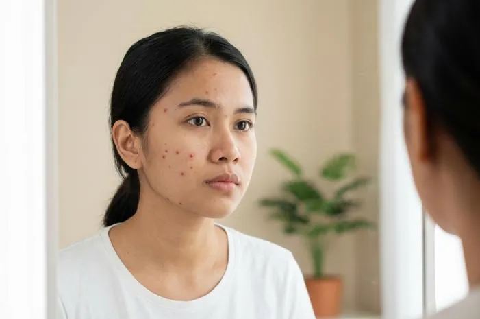 Kenapa Cacar Air Banyak di Wajah? Ini Alasannya