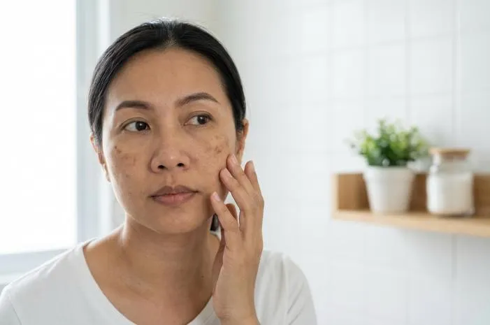Basmi Dark Spots Wajah: Tips Ampuh Bikin Mulus