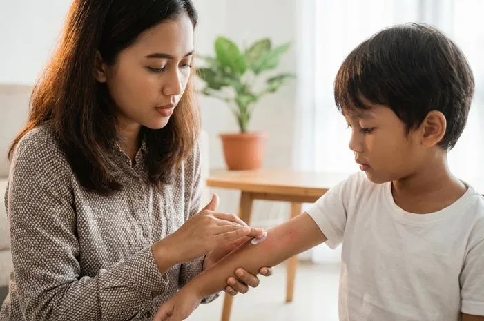 Cacar Nanah Obati Segera Cegah Infeksi dan Bekas Luka