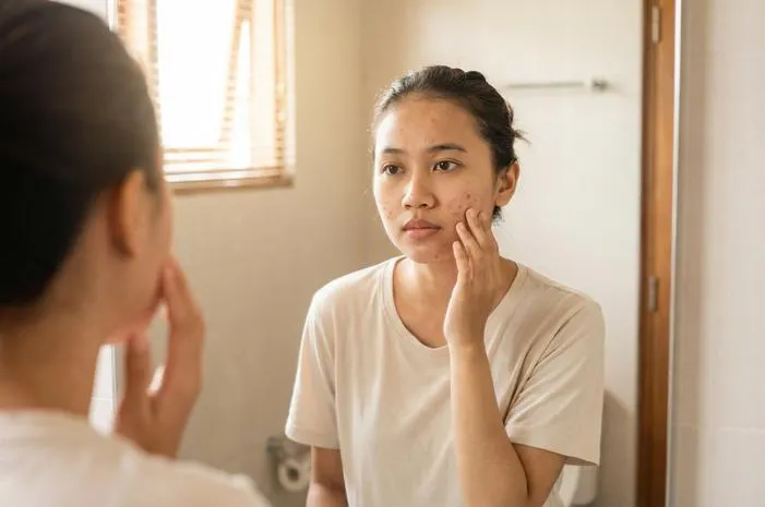 Cacar di Muka Hilang Tuntas, Wajah Mulus Tanpa Bopeng