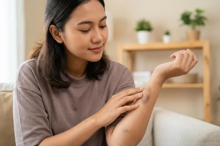 Bruises: Simak Penyebab dan Cara Mudah Sembuhkannya