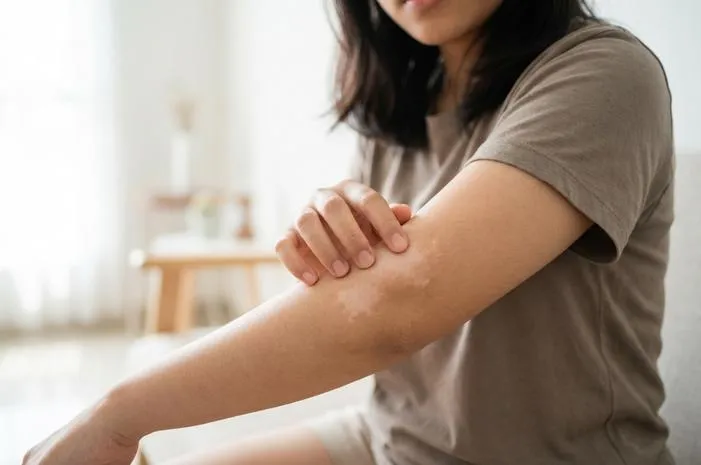 Tanda Lahir Warna Putih Itu Normal Kok, Ini Faktanya!