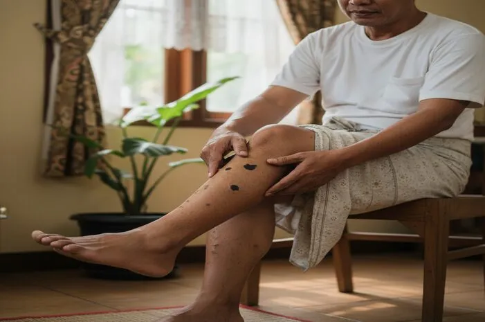 Bercak Hitam di Kaki karena Diabetes: Kenali Lalu Atasi