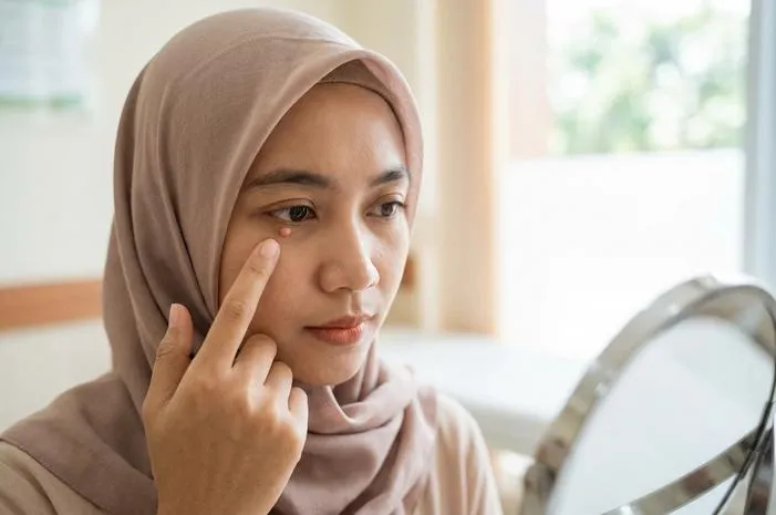 Kutil Mata Bikin Tak Pede? Ini Cara Mengatasinya