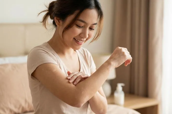 Vitiligo Ringan? Ini Cara Atasi Tanpa Panik