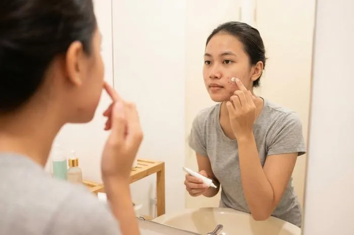 Cinolon N untuk Jerawat: Solusi atau Malah Bumerang?