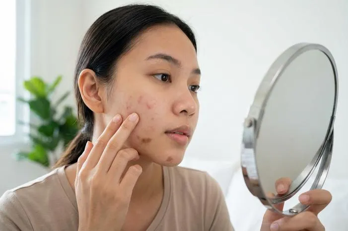 Beda PIE dan PIH: Kenali Warna dan Cara Atasi