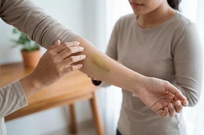 Memar Warna Kuning: Tanda Sembuh atau Bahaya?