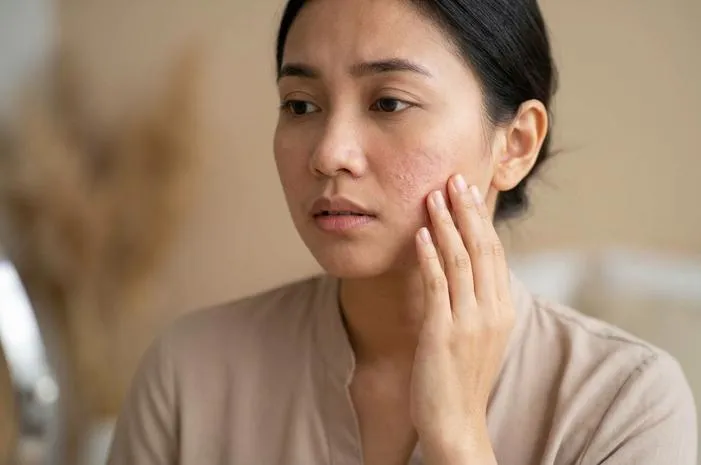 Tips Jitu Atasi Muka Kering dan Gatal, Kulit Lembap