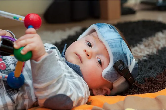Cranial Helmet: Solusi Efektif Atasi Kepala Bayi Peyang