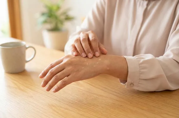 Bintik Bintik di Tangan Tidak Gatal? Ini 8 Sebabnya