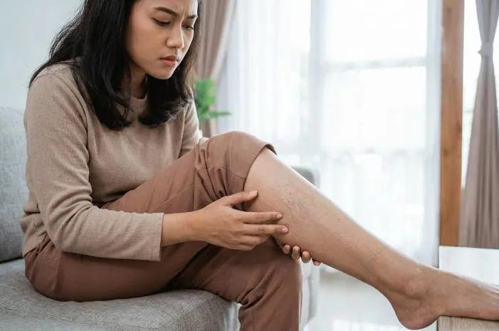 Spider Veins Muncul? Pahami Penyebab dan Cara Atasi