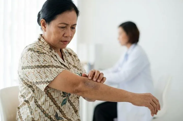 Cara Ampuh Atasi Penyakit Kulit Hitam Seperti Terbakar