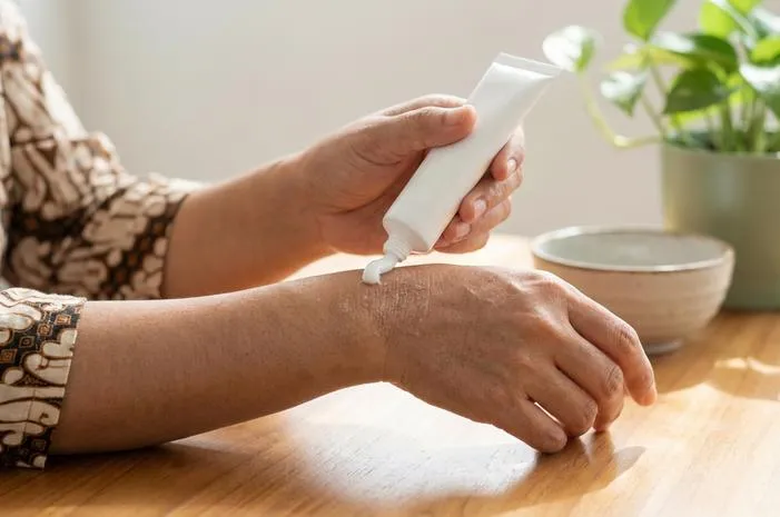 Obat Salep Eksim Kering: Ampuh Atasi Gatal dan Kulit Kering