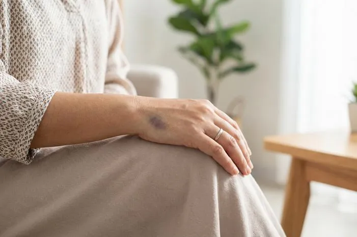 Tangan Memar Biru? Pahami Sebab dan Cara Mengatasinya.