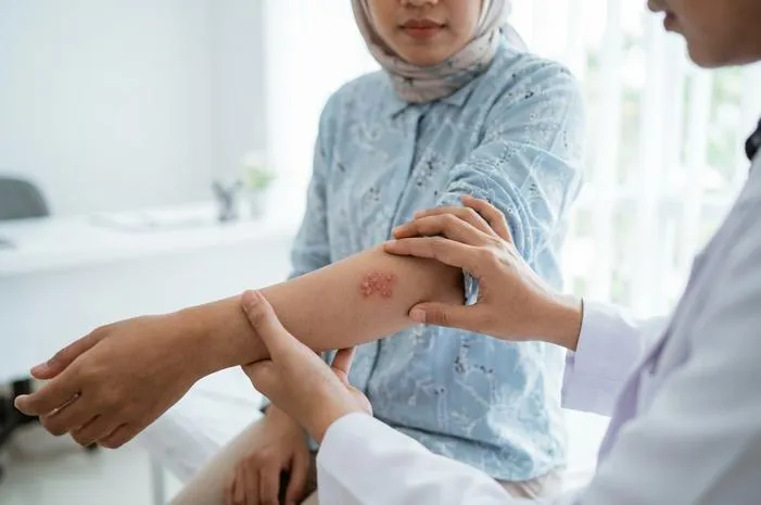 Ciri Herpes Kulit: Yuk, Kenali Tanda dan Gejalanya