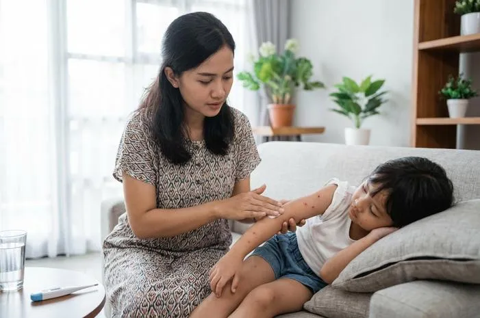 Sakit Cacar Air Berapa Lama? Sembuh Tuntas 7-14 Hari.