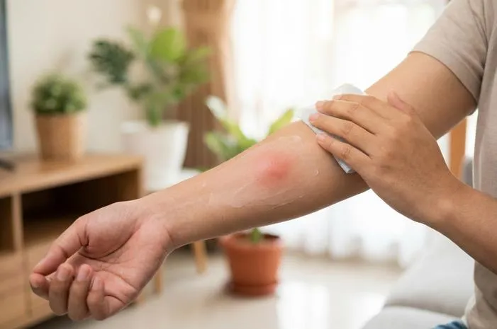 Digigit Nyamuk Sampai Bengkak? Atasi Cepat, Gatal pun Lenyap!