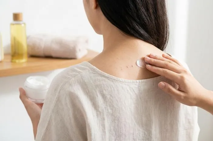 Cara Hilangkan Bekas Jerawat Punggung, Mulus Kembali!