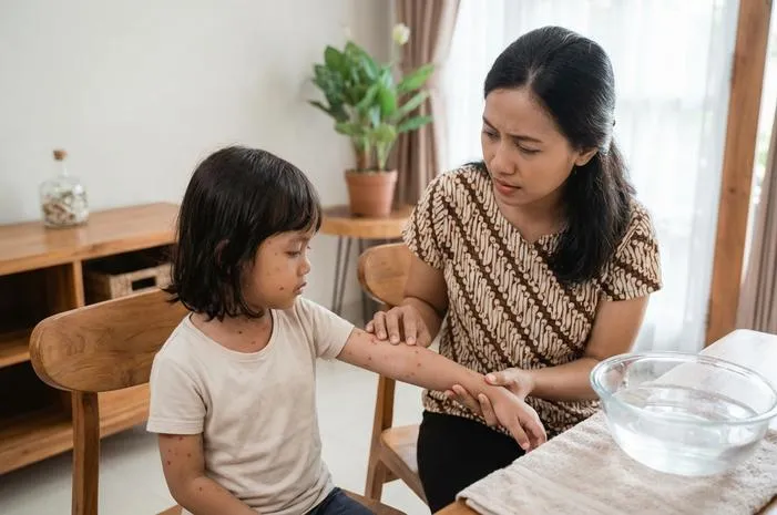Yuk Kenali Jenis Cacar pada Anak, Jangan Sampai Salah!