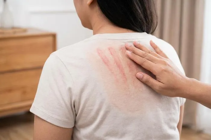 Bekas Kerokan di Kulit: Fakta, Bukan Angin Keluar