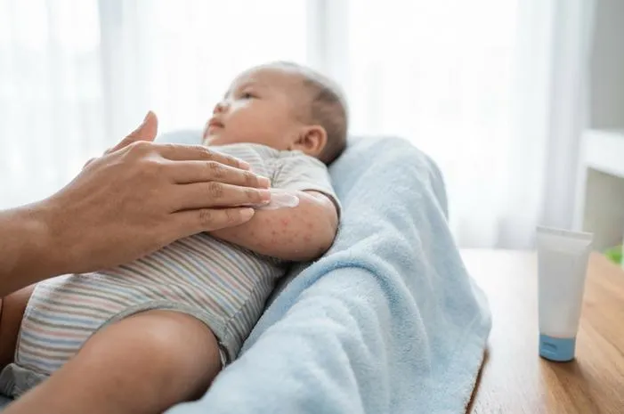 Kulit Bayi Beruntusan Biang Keringat? Bikin Nyaman Lagi!