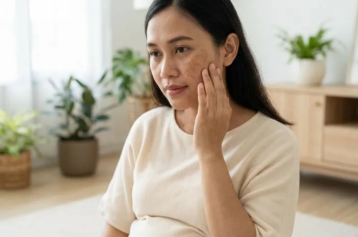 Chloasma Gravidarum: Atasi Flek Topeng Kehamilan