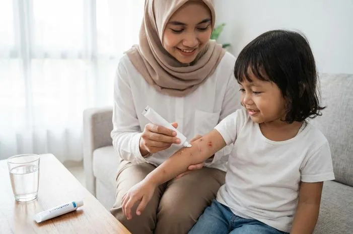 Salep Cacar Air Agar Tidak Membekas: Pilih Ini!