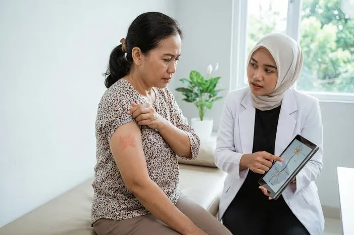 Terkuak! Cacar Api Disebabkan oleh Virus Tidur Ini