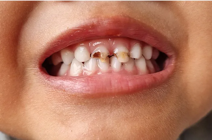 Gigi Anak Berlubang, Apa Solusinya? Ini yang Perlu Ibu Pahami