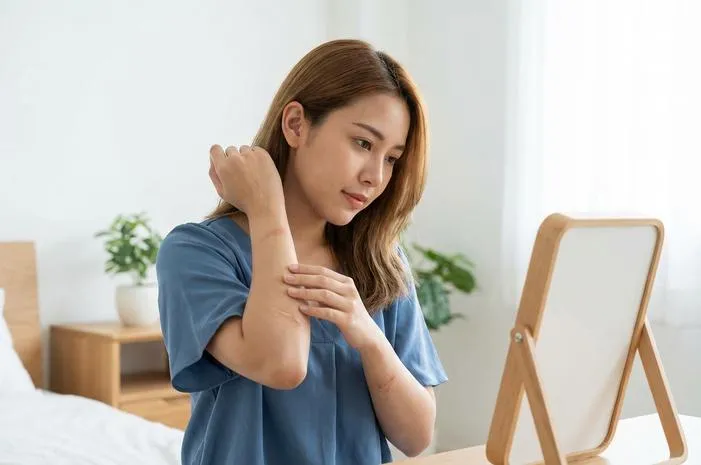 Apakah Campak Berbekas? Simak Cara Agar Kulit Mulus Kembali