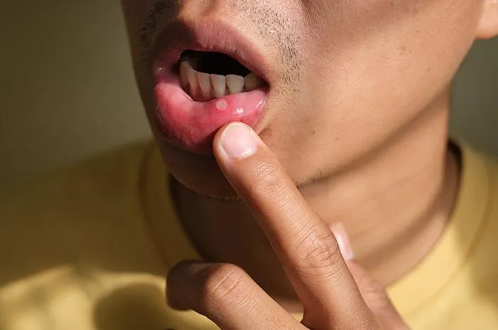 Sariawan Pinggir Bibir? Tenang, Ini Cara Mudah Obati