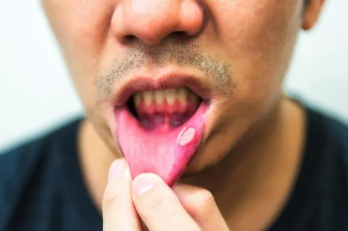 Obat Nystatin Drop Sariawan: Mudah Redakan Perih Mulut