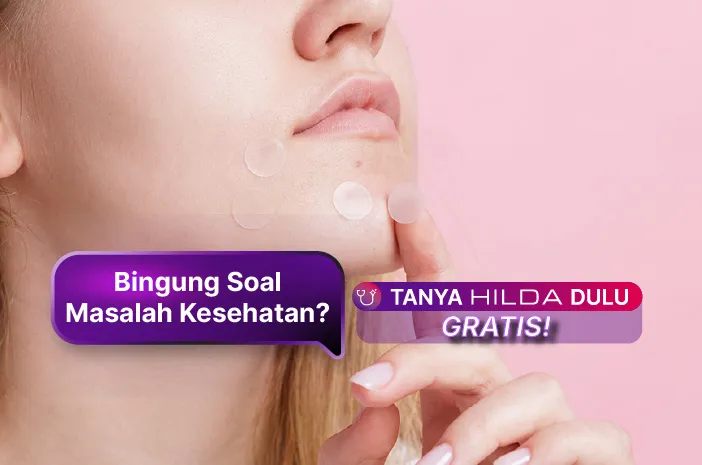 Cara Pakai Acne Patch: Bye Jerawat! Mudah Banget!
