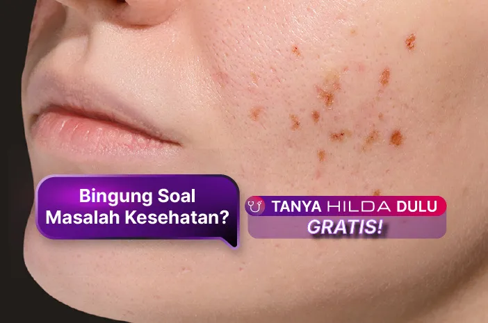 Ini Cara Menghilangkan Bopeng di Wajah