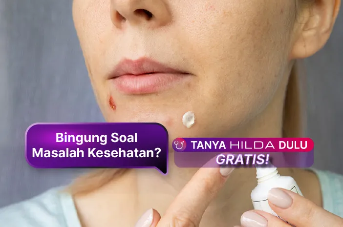 Salep Jerawat Resep Dokter, Solusi Efektif untuk Kulit Bersih dan Sehat