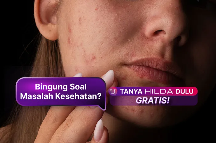 Pilihan Obat Bruntusan di Wajah di Apotik yang Ampuh dan Aman