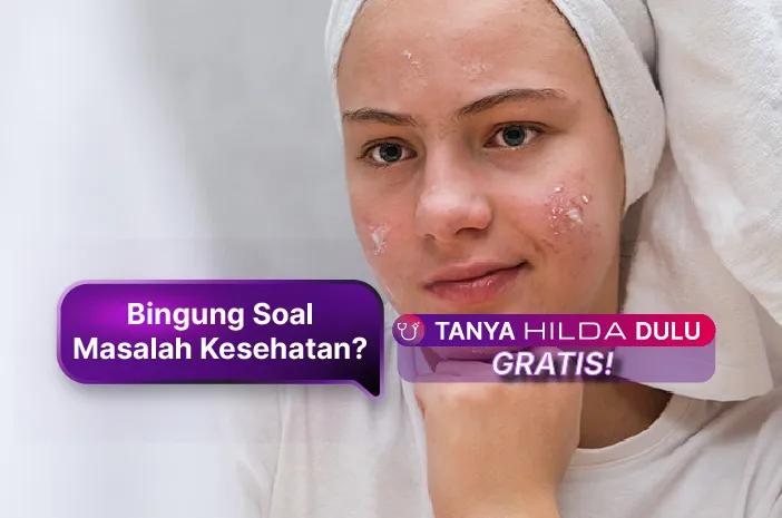Ini Cara Mengobati Jerawat dan Pencegahannya